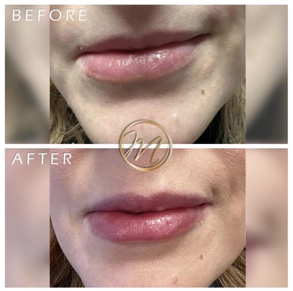 Lip filler before and after — CosMedic LaserMD patient